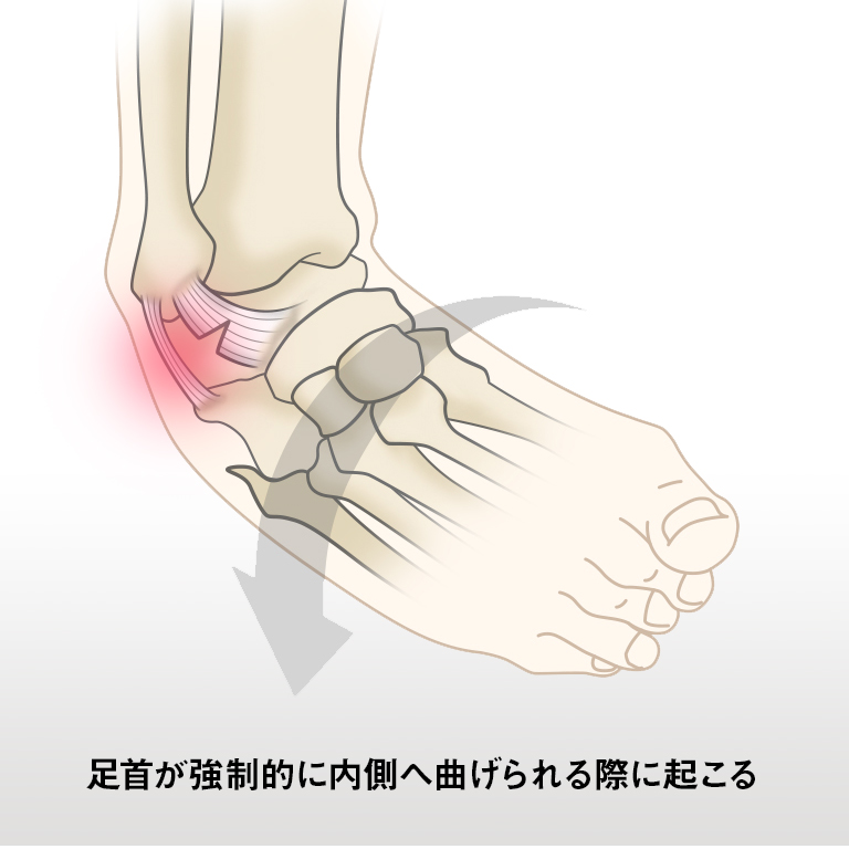 足 の 痛み 部位 別 図