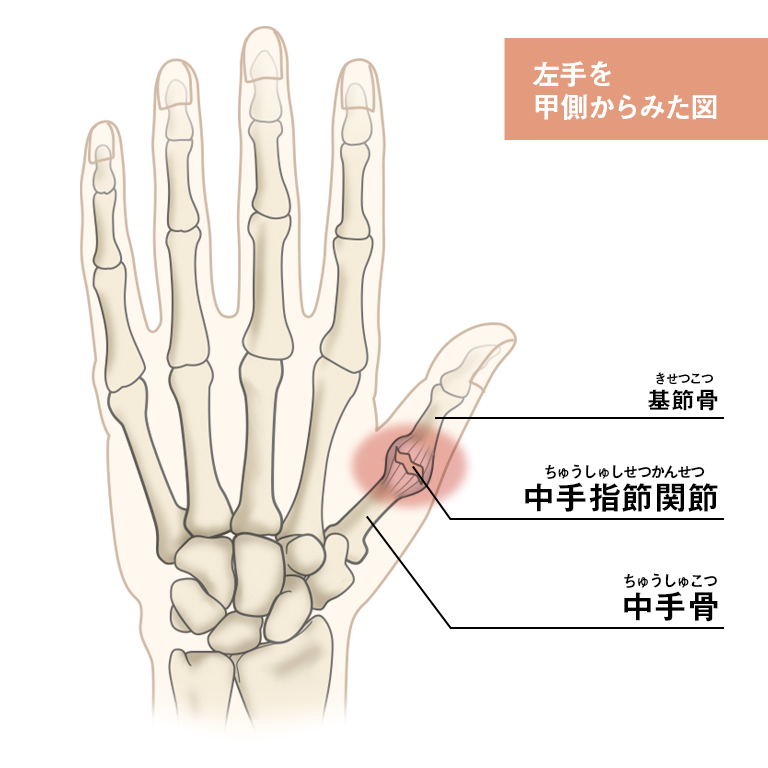 痛み 付け根 親指 の の 第7回 「強剛母趾」を知っていますか～親指付け根の痛み、痛風とは限りません～｜足の悩み、一挙解決｜時事メディカル｜時事通信の医療ニュースサイト