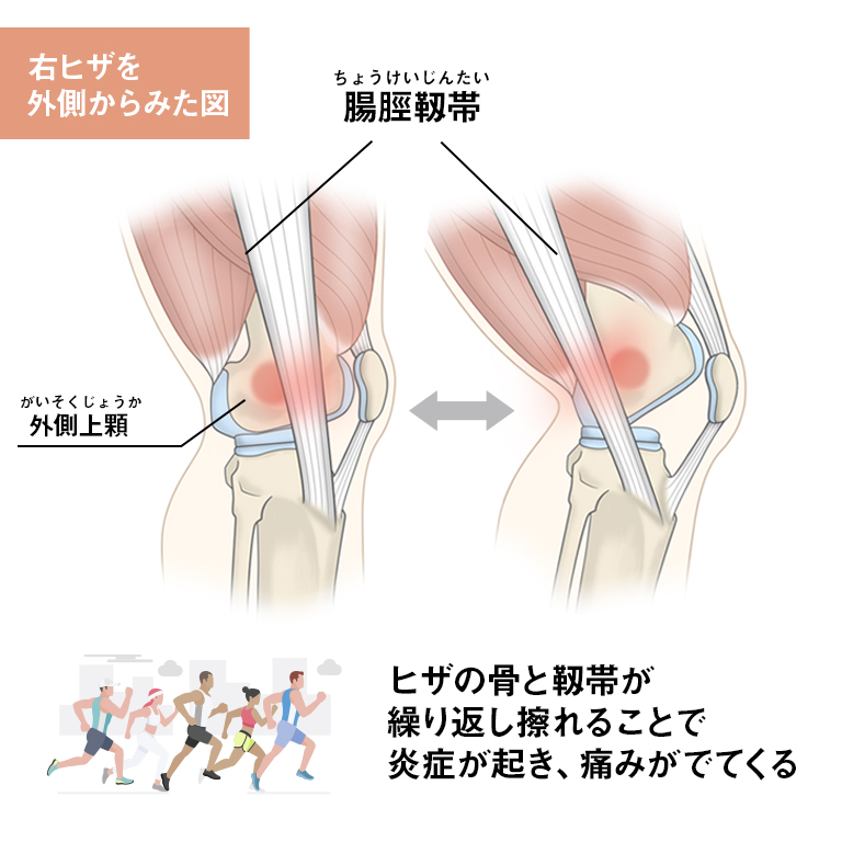 脛 ストレッチ 腸 靭帯 腸脛靭帯炎（ランナーズニー）を予防・改善する為のストレッチ