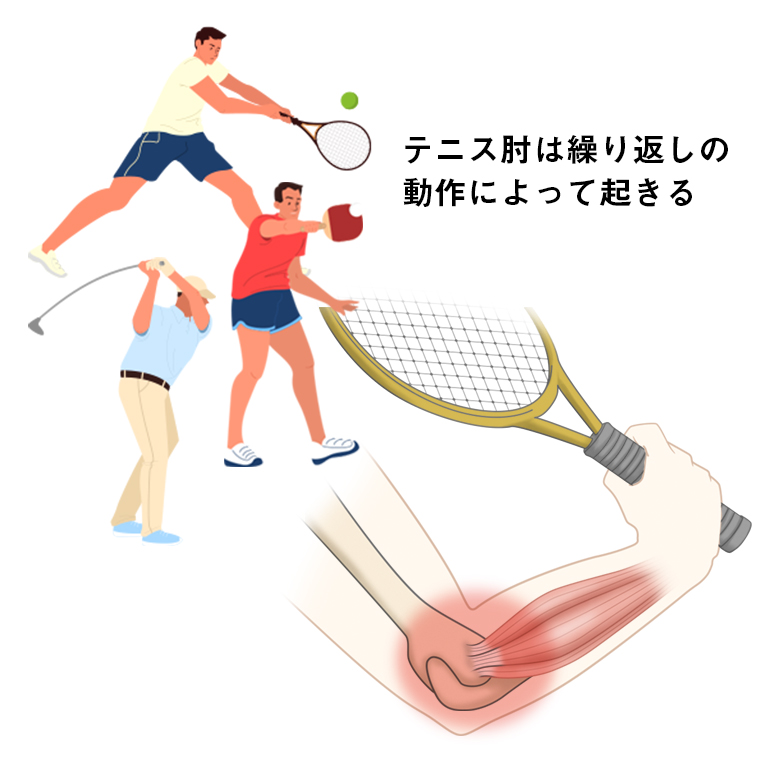肘 と は テニス 外側上顆炎（テニス肘と呼ばれる肘の外側の痛み）の症状・原因と予防法｜スポーツによる慢性の痛み｜痛みwith
